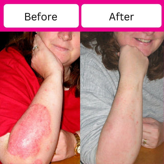 Premium Eczema Cream TGA 413657