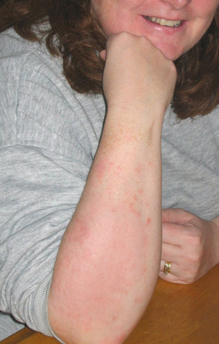 Premium Eczema Cream TGA 413657