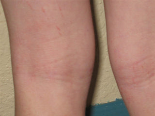 Premium Eczema Cream TGA 413657